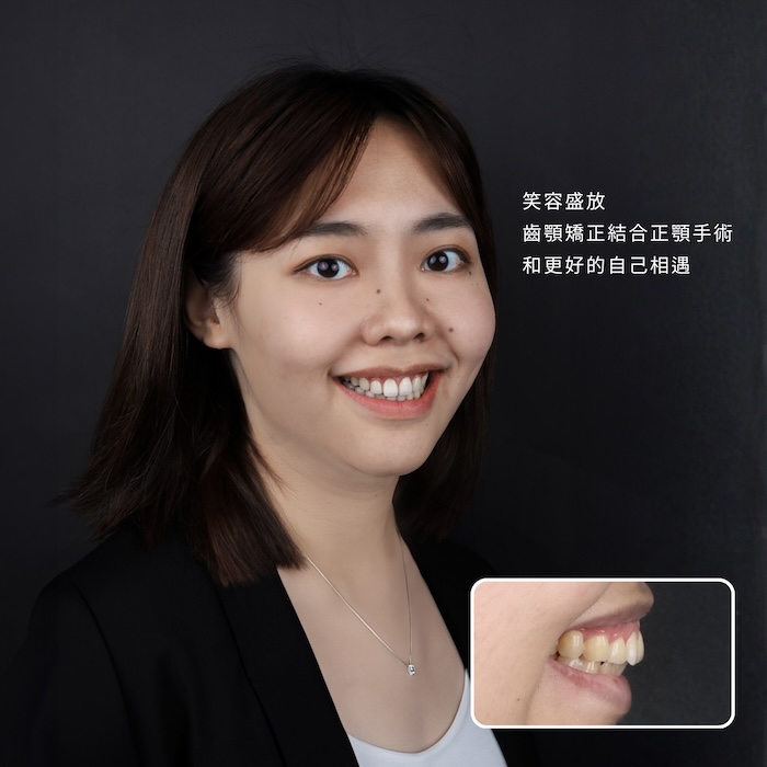 笑容盛放，齒顎矯正結合正顎手術，和更好的自己相遇