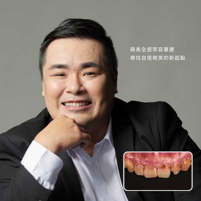 蒔美全瓷笑容重建，尋找自信微笑的新起點