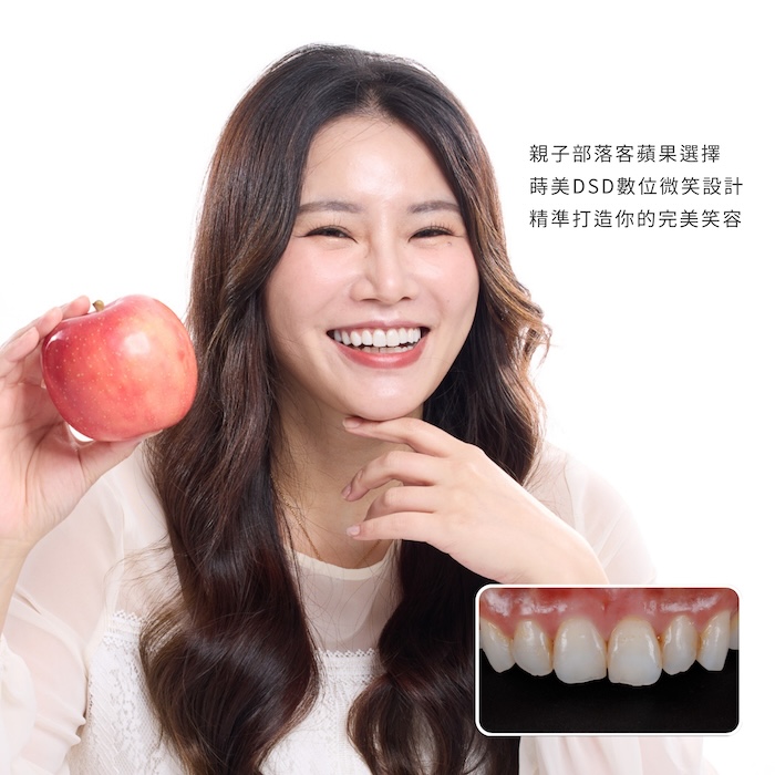 親子部落客蘋果，選擇蒔美DSD數位微笑設計，精準打造你的完美笑容！
