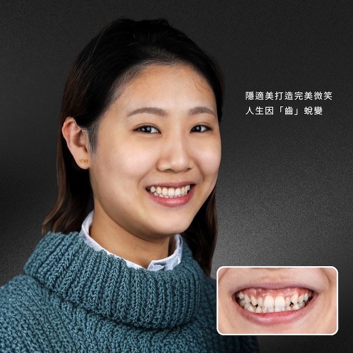 隱適美打造完美微笑，人生因「齒」蛻變｜板橋隱適美素人案例分享