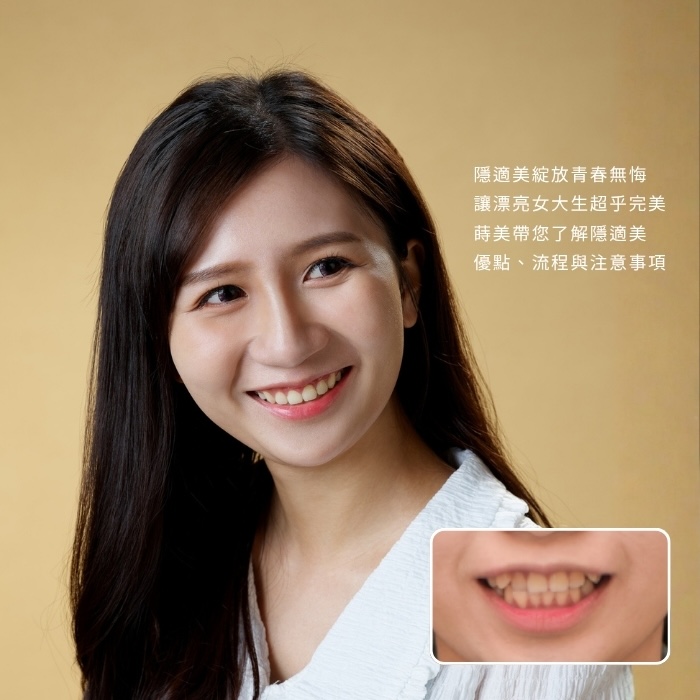 隱適美綻放青春無悔，讓漂亮女大生超乎完美｜板橋蒔美隱適美案例，帶您了解隱適美優點、流程與注意事項
