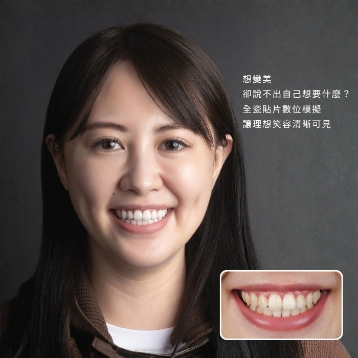 想變美,卻說不出自己想要什麼?全瓷貼片數位模擬,讓理想笑容清晰可見 Want a Better Smile, but Not Sure What You Want Digital Veneer Design Makes It Visible