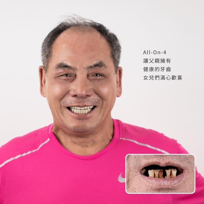 All-On-4讓父親擁有健康的牙齒，女兒們滿心歡喜