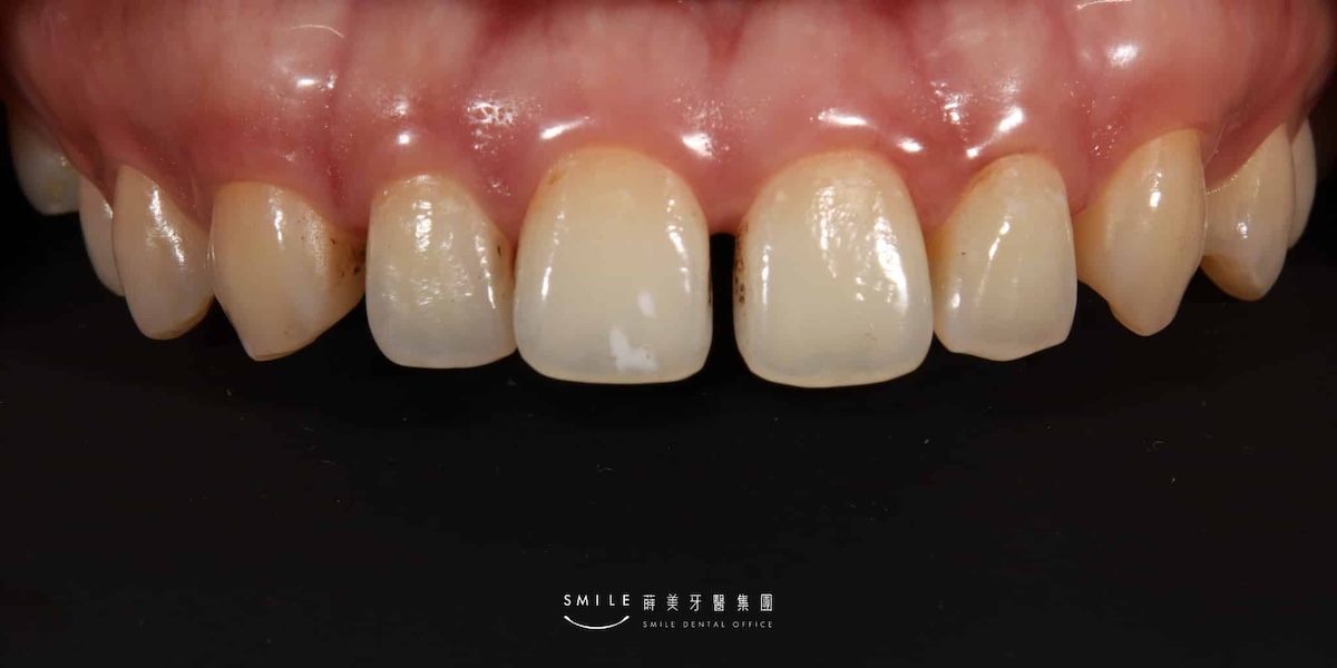 全瓷貼片案例蒔美牙醫8