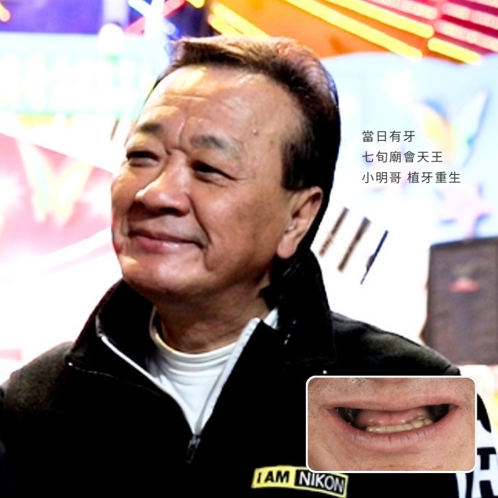 當日有牙！七旬廟會天王小明哥 植牙重生