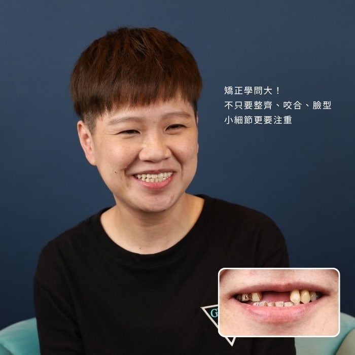 矯正學問大！不只要整齊、咬合、臉型，小細節更要注重｜板橋矯正素人案例｜蒔美牙醫