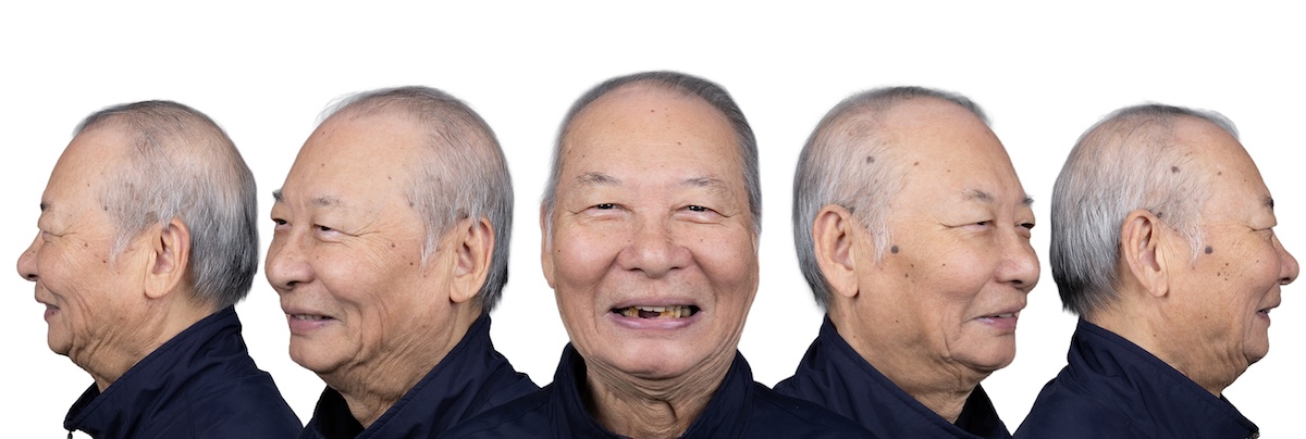 張 術前五面圖