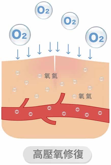 高壓氧插圖-